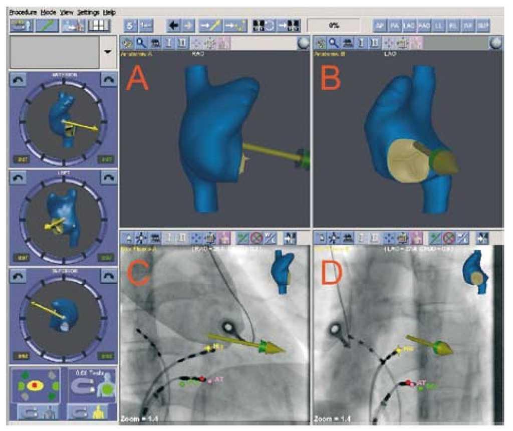 atrioventricular,coronary ablation of atrioventricular nodal reentrant tachycardia using