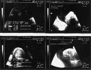 Diagn Stico Prenatal De La Displasia Campom Lica A Prop Sito De Un