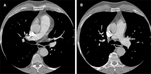 Tromboembolia Pulmonar Y Tomograf A Multicorte Revista Espa Ola De