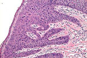 Neoplasia Intraepitelial Anal Medicina Cl Nica