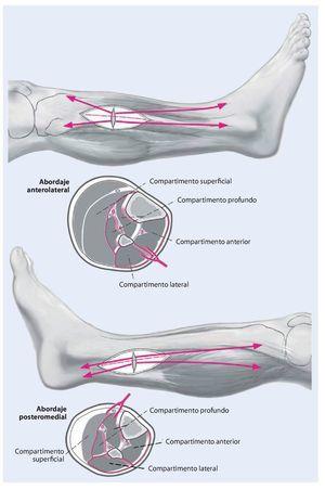 S Ndrome Compartimental Agudo De La Pierna T Cnicas Quir Rgicas En