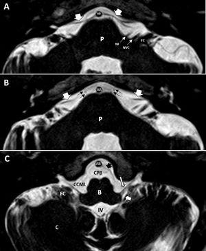 Cortes axiales de ambos oídos, secuencias hiperpotenciadas en T2. A) Salida del origen aparente de los nervios facial (NF) y vestibulococlear (NVC) en íntima relación con el flóculo cerebeloso (FC). Se observa cómo sale la arteria cerebelosa anteroinferior (flechas blancas gruesas) de la arteria basilar (AB). B) Corte a nivel más superior, donde se siguen observando las arterias cerebelosas anteroinferiores en su trayecto posterior, en relación a los pares craneales VII y VIII. También se identifica a este nivel el VI PC (flechas negras) en su trayecto hacia el canal de Dorello, en la porción anterior del ápex petroso. C) Corte axial a nivel del IV ventrículo (IV) y del foramen de Luschka (flecha blanca gruesa). Identificamos la salida de los pares craneales bajos IX o X (flecha blanca larga) en íntima relación con el flóculo cerebeloso, así como su trayecto lateral atravesando la cisterna cerebelomedular lateral (CCML) hacia el foramen yugular. Flecha negra gruesa, arteria cerebelosa posteroinferior. B: bulbo; C: cerebelo.