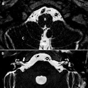 Cortes axiales, secuencias hiperpotenciadas en T2. A) Identificamos las dos arterias vertebrales (AV), en relación con el XII PC (flechas negras), en su trayecto hacia el canal condíleo o del hipogloso. B: bulbo; C: cerebelo; CM: cisterna magna; CPB: cisterna prebulbar. B) Bucle de la arteria cerebelosa anteroinferior (flecha blanca gruesa) en oído derecho, que se introduce <50% en el interior del conducto auditivo interno (grado II de la clasificación de Chavda). En oído izquierdo se observa cómo la arteria cerebelosa anteroinferior no se introduce en el conducto auditivo interno (grado I de la clasificación de Chavda) (flecha blanca fina). Flecha negra gruesa, VI PC. AB: arteria basilar.