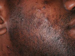 Pseudofoliculitis de intensidad moderada en un paciente de raza negra.