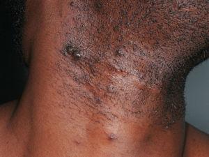 Pseudofoliculitis de intensidad moderada con lesiones hiperpigmentadas en un paciente de raza negra.