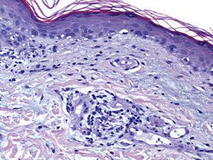 Focos de hiperqueratosis ortoqueratósica compacta con leve adelgazamiento epidérmico y moderado infiltrado inflamatorio vascular superficial formado por linfocitos, así como dermatitis de la interfase con degeneración vacuolar y cuerpos de Civatte (hematoxilina-eosina, x40).