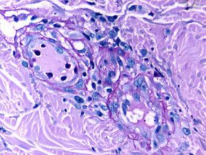 Dermis homogeneizada y vasos trombosados en la dermis papilar, ocupando su luz un material eosinófilo homogéneo y fibrilar sugestivo de trombos fibrino-plaquetarios (PAS, x200).