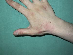 Dermatitis subaguda típicamente localizada en el dorso de las manos.