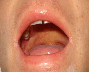 Enantema de Nagayama. Enantema purpúrico en el paladar blando y la base de la úvula, característico de la infección por VHH-610.