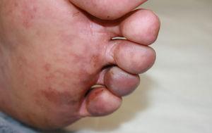 Coloración azul del cuarto y quinto dedo del pie izquierdo con máculas violáceas reticuladas en el resto de los dedos y en la planta del pie.