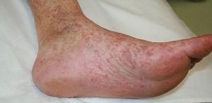 Máculas violáceas reticuladas que se extienden al resto del pie y hacia la zona distal de la pierna.