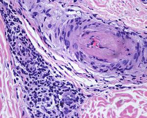 Arteriola de mediano calibre con trombo mural. No se observan signos de vasculitis (H-E x40).