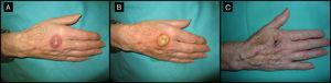 Mujer de 80 años con lesión clínica e histológicamente compatible con QA de 4 meses de evolución (caso 5, tabla 1). A. Lesión de 2,5cm de tamaño, localizada en el dorso de la mano derecha. B. Aspecto amarillento de la lesión tras infiltración de MTX-il. C. En el momento de la cirugía reducción de la lesión a una pequeña tumoración de 1cm de diámetro.