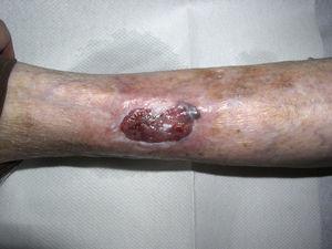 Lesión tumoral ulcerada remitida como úlcera crónica, correspondiente a un carcinoma basocelular.