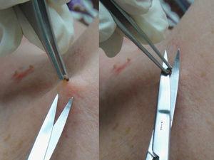 Aplicación de la técnica de corte tangencial con tijera en el caso de un fibroma.