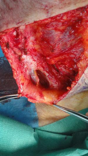 Exposición de la yugular interna durante cirugía de extirpación de ganglio centinela de región cervical.