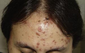 Caso 9: pápulas y placas eritemato-violáceas, a nivel de las cicatrices de varicela previa.