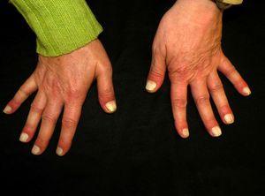 Blanqueamiento completo de la lámina ungueal que afecta a las 10 uñas de las manos.