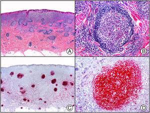 Linfoma cutáneo primario de células B folicular. A) Visión panorámica. B) Detalle de uno de los folículos linfoides neoplásicos con centro germinal. C) El mismo caso estudiado inmunohistoquímicamente con Bcl-6. D) Positividad de los linfocitos neoplásicos para el Bcl-6.