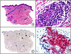 Infiltración cutánea por leucemia linfática crónica de células B. A) Visión panorámica. B) Infiltrado de linfocitos de pequeño tamaño alrededor de los vasos de la dermis. C) El mismo caso estudiado inmunohistoquímicamente con CD20. D) Positividad de las células neoplásicas para CD20.