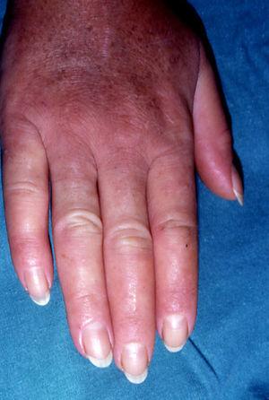 Esclerodermia sistémica en linfoma (manos esclerodermiformes).