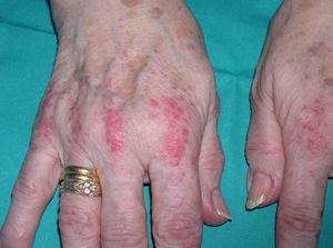 Dermatomiositis (pápulas de Gottron).