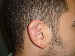 Se observa una lesión nodular en el borde superior del pabellón auricular, que a la palpación es de consistencia blanda.