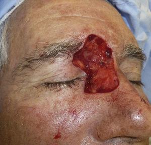 Herida en el canto interno del ojo derecho tras la tercera etapa de cirugía de Mohs.