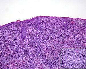 Biopsia de piel mostrando un infiltrado linfohistiocítico dérmico difuso, que incluye numerosos granulomas pobremente formados (H-E×100). En el recuadro inferior derecho se observa a gran aumento un granuloma epitelioide no necrotizante (H-E ×400).
