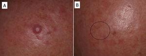 A. Linfoma cutáneo de células B del manto localizado en el cuero cabelludo, como lesión única. B. Tras dos infiltraciones (10mg/ml), con un intervalo de un mes, se observó resolución de la lesión. No se han observado recidivas 8 meses después.