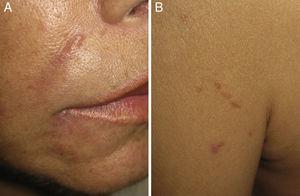 A) Aspecto clínico de los nódulos en un pliegue nasolabial. B) Aspecto clínico de las pápulas lineales en una cicatriz antigua.