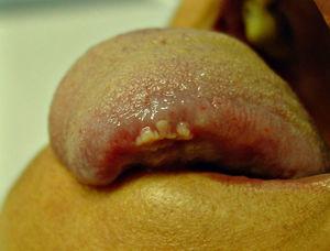 Caso 5. Lesiones papilomatosas blanquecinas en el borde lateral de la lengua.