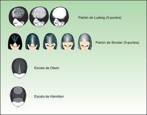 Patrón femenino de la alopecia androgenética (alopecia difusa progresiva).