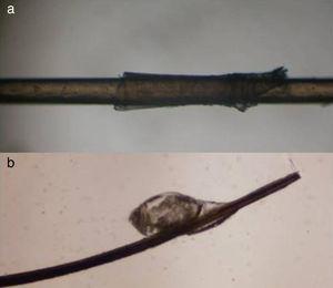 Observación del tallo: depósito de sustancias. A. Cabello enfundado. B. Pediculosis capitis. Microscopio optico (x40).