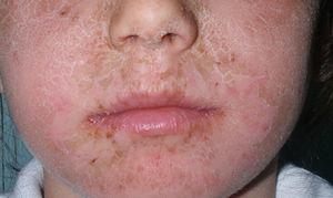 Niño con dermatitis alérgica de contacto facial por octocrileno.