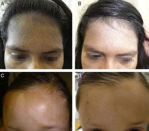 A y B. Nevus de Ota bilateral antes y después de la sesión de maquillaje corrector. C y D. Hipomelanosis de Ito antes y después de la sesión de maquillaje corrector.