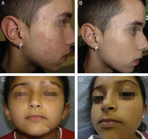 A y B. Cicatrices postacné antes y después de la sesión de maquillaje corrector. C y D. Vitíligo segmentario antes y después de la sesión de maquillaje corrector.
