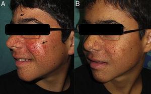 A. Angiofibromas faciales y máculas hipomelanóticas antes del tratamiento. B. Después de 20 semanas de rapamicina tópica al 0,2%.