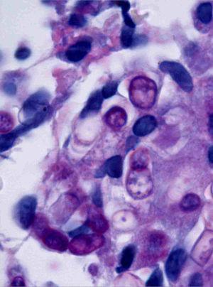 Round, fungal structures within a granuloma. One of the round structures is septate (periodic acid-Schiff 1000×).