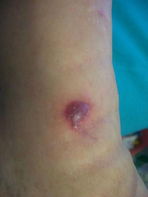Reddish nodular skin lesion on the left leg.