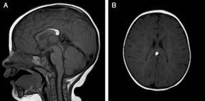 Interhemispheric hyperintense structure on T1-weighted image consistent with a lipoma associated with hypoplasia of the splenium of the corpus callosum (bright fat tissue on T1 sequence). (A) Sagittal plane. (B) Transverse/axial plane.