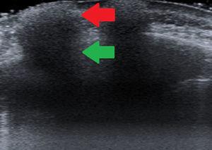 Siliconomas con el patrón en «tormenta de nieve». Flecha roja: imagen hiperecogénica que corresponde al material de relleno. Flecha verde: sombra acústica posterior.