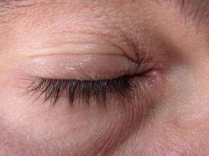 Eccema alérgico de contacto leve de párpados tras aplicación de un producto cosmético.