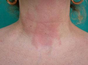 Eccema alérgico de contacto en la región cervical anterior por fragancias.