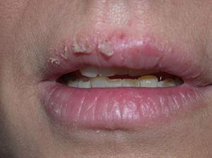 Queilitis por galatos presentes en una barra labial.