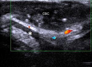 Carcinoma basocelular (CBC) auricular. Asterisco: cartílago auricular.