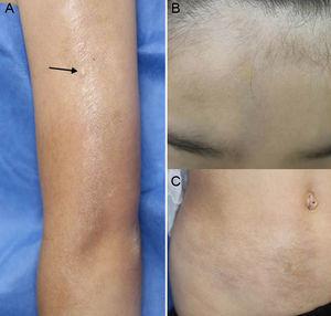 (A) Clinical appearance of the linear sclerotic plaque on the patient's arm. The Bacille Calmette-Guerin vaccination scar is shown by the arrow. (B) Linear sclerotic plaque on the forehead. (C) Morphea plaque on the right abdomen.