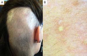 (A) Rectangular bald patch in the right occipital–parietal region. (B) Normal density of follicular openings, absence of terminal hairs, and presence of vellus-type hairs and yellow dots (original magnification 20×).