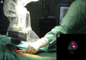 A. Exploración con gammacámara portátil de campo quirúrgico para localización de incisión dirigida. B. Imagen obtenida de ganglio centinela mediante gammacámara portátil.