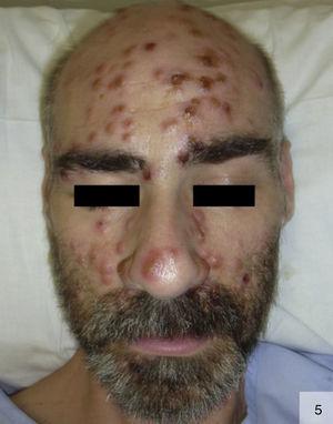 Sífilis pustulosa generalizada. Detalle de la afectación facial (por cortesía de la Dra. Irene Fuertes).